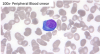 HHV8 Positive MCD- Plasmablasts on peripheral smear