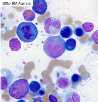 HHV8 Positive MCD- Plasmablasts on Bone Marrow Aspirate