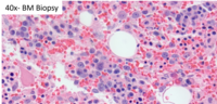 HHV8 Positive MCD- Plasmablast on Bone Marrow biopsy