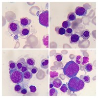 Refractory Anemia with Ring Sideroblasts