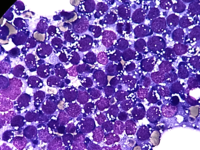 Burkitt's Lymphoma