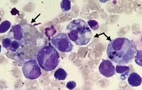 Hemophagocytic Lymphohistiocytosis