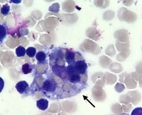 Macrophage with phagocytosed red blood cells