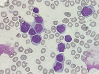 Mantle Cell Lymphoma