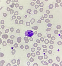 Howell - Jolly body -like inclusions in neutrophils 1