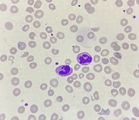 Howell - Jolly body -like inclusions in neutrophils 2