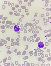 Howell - Jolly body -like inclusions in neutrophils 3