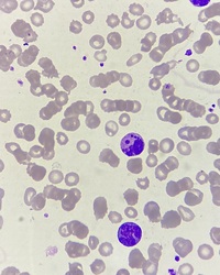 Howell - Jolly body -like inclusions in neutrophils 4