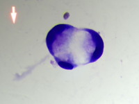 Metastatic carcinoma with signet ring differentiation 1