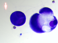 Metastatic carcinoma with signet ring differentiation 3