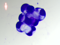 Metastatic carcinoma with signet ring differentiation 4