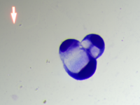 Metastatic carcinoma with signet ring differentiation 5