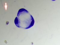 Metastatic carcinoma with signet ring differentiation 6