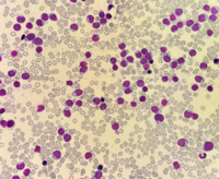 Blastic Plasmacytoid Dendritic Cell Neoplasm 1