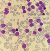 Blastic Plasmacytoid Dendritic Cell Neoplasm 2