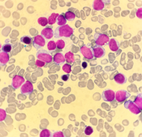 Blastic Plasmacytoid Dendritic Cell Neoplasm 3