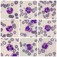 Dysmorphic Eosinophils