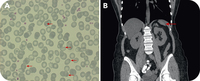 Thrombocytosis