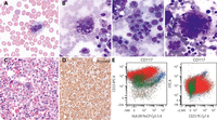 A challenging case of mast cell sarcoma primarily involving the bone marrow