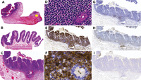 Monomorphic epitheliotropic T-cell lymphoma with strong CD4 expression