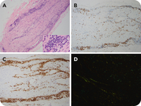 An unusual presentation of lymphoplasmacytic lymphoma with isolated brachial plexus infiltration and amyloidosis