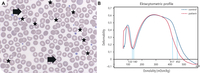 Polycythemia revealing PIEZO1 hereditary xerocytosis