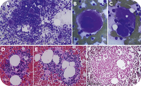 A 1-year-old child with essential thrombocythemia