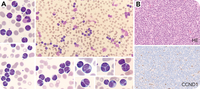 Binucleated and cloverleaf-shaped nucleus in lymphocytes in CLL