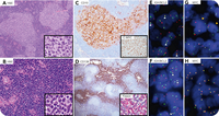 Double-hit, double-expressor follicular lymphoma with plasmacytic differentiation