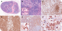 Mantle cell lymphoma with marked plasmacytic differentiation: two contrasting faces