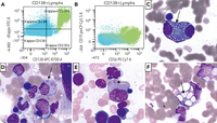 Snapper-Schneid bodies (coarse cytoplasmic granules) in a patient with multiply relapsed multiple myeloma