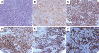 Thymoma with aberrant expression of CD20: a potential diagnostic pitfall of B-cell lymphoma