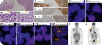 Transformed mantle cell lymphoma with additional triple-hit genotypes can be resistant to a Bruton tyrosine kinase inhibitor