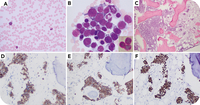 AEL transformed from post-ET myelofibrosis with a sinusoidal pattern, JAK2 mutation, and biallelic TP53 inactivation