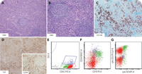 Castleman disease with modest T-lymphoblastic proliferation