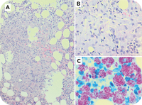 Unmasking atypical bone marrow TB