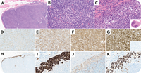 Occult ALK-negative anaplastic large cell lymphoma complicating chronic lymphocytic leukemia