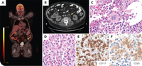 An unusual presentation of systemic mastocytosis in a myelolipoma