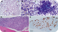 A 3-year-old with chronic myeloid leukemia