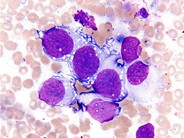 bone marrow with embryonal rhabdomyosarcoma metastasized