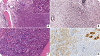 PCM1::JAK2 myeloproliferative neoplasm suggested by bone marrow histopathological features