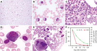 Chronic eosinophilic leukemia with a novel JAK1 mutation responds well to the JAK1/2 inhibitor ruxolitinib