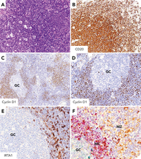 Mantle cell lymphoma with IRTA1 reactive expansion of the marginal zone