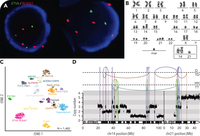 B-ALL with intrachromosomal amplification of chromosome 21 in a carrier of the Robertsonian translocation rob(14;21)c