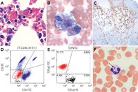 Hemophagocytic lymphohistiocytosis with γ/δ T-cell expansion secondary to anaplasmosis