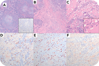 KSHV/HHV-8-associated multicentric Castleman disease and nodal Kaposi sarcoma displaying a lymphangiectatic pattern