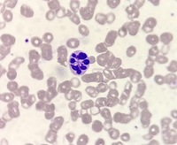 Botryoid neutrophil