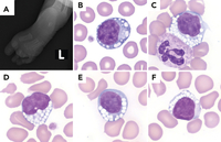 Neonatal blood smear with vacuolated lymphocytes