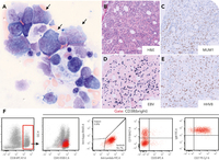 HHV-8 diffuse large B-cell lymphoma with EBV coinfection occurring posttransplant