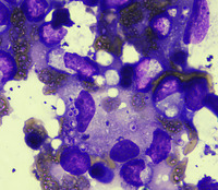 Bone marrow histoplasmosis. BMAX100